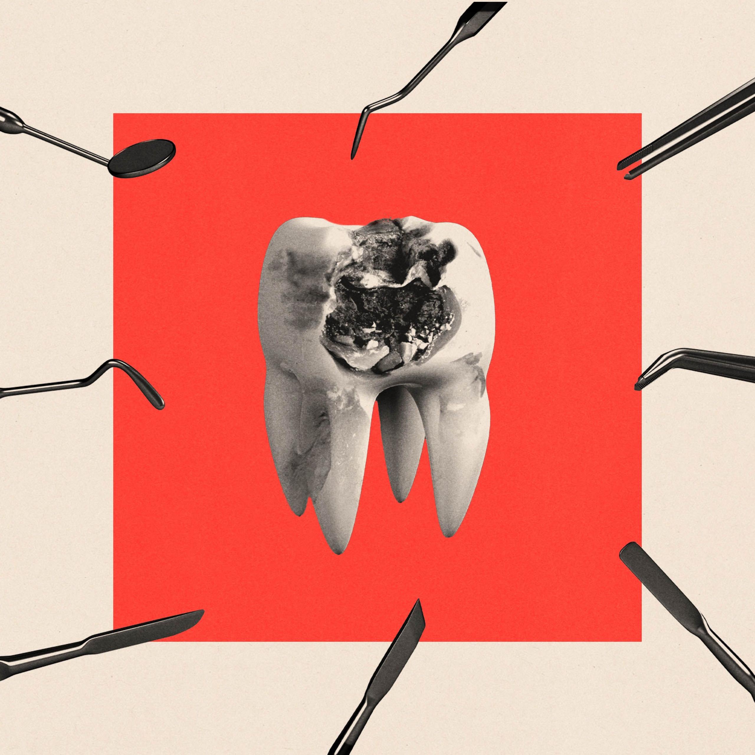 A treated image of a singular tooth with an infection. It is surrounded by dentistry tools.